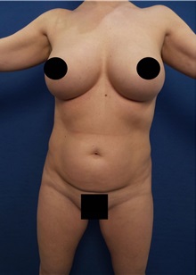 Liposuction Before Photo by Arian Mowlavi, MD; Laguna Beach, CA - Case 34322