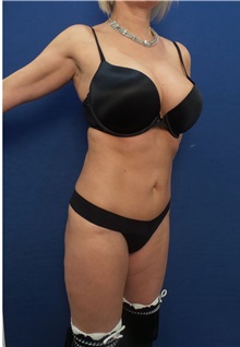 Liposuction After Photo by Arian Mowlavi, MD; Laguna Beach, CA - Case 34322