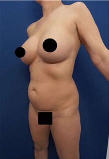 Liposuction Before Photo by Arian Mowlavi, MD; Laguna Beach, CA - Case 34322