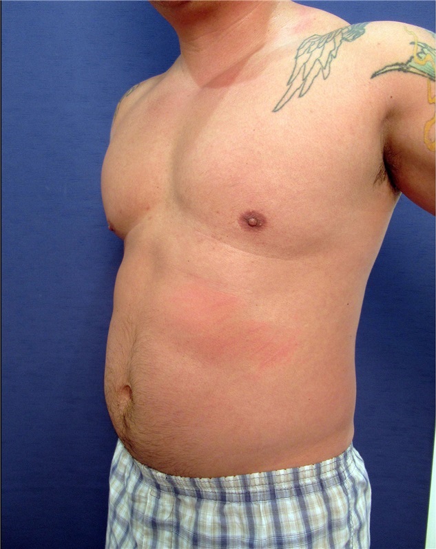 Liposuction Before and After Photos by Arian Mowlavi, MD