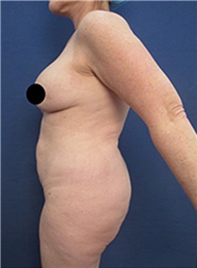 Liposuction Before Photo by Arian Mowlavi, MD; Laguna Beach, CA - Case 34327