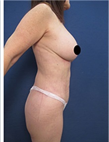 Liposuction After Photo by Arian Mowlavi, MD; Laguna Beach, CA - Case 34327