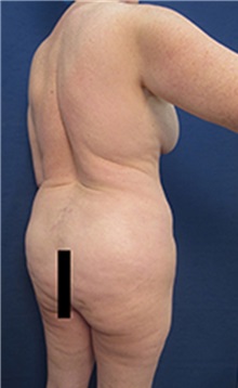 Liposuction Before Photo by Arian Mowlavi, MD; Laguna Beach, CA - Case 34327