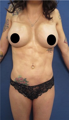 Liposuction After Photo by Arian Mowlavi, MD; Laguna Beach, CA - Case 34647