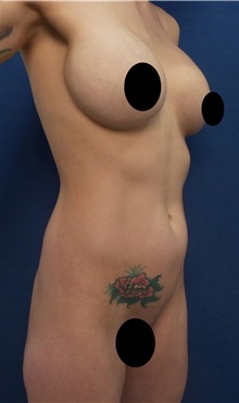 Liposuction Before Photo by Arian Mowlavi, MD; Laguna Beach, CA - Case 34647
