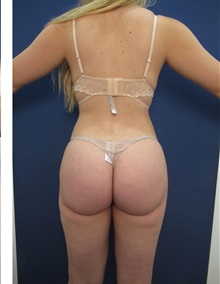 Buttock Lift with Augmentation After Photo by Arian Mowlavi, MD; Laguna Beach, CA - Case 35196