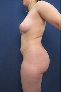 Buttock Lift with Augmentation Before Photo by Arian Mowlavi, MD; Laguna Beach, CA - Case 35196