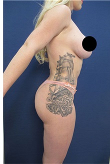 Buttock Lift with Augmentation After Photo by Arian Mowlavi, MD; Laguna Beach, CA - Case 35198