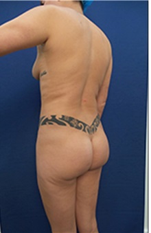 Liposuction Before Photo by Arian Mowlavi, MD; Laguna Beach, CA - Case 35201