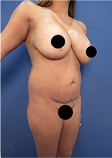 Breast Augmentation Before Photo by Arian Mowlavi, MD; Laguna Beach, CA - Case 35222