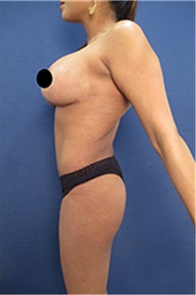 Breast Augmentation After Photo by Arian Mowlavi, MD; Laguna Beach, CA - Case 35222