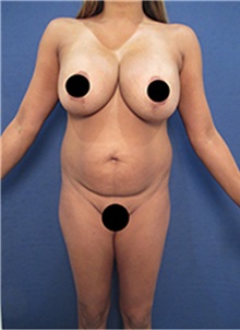 Breast Augmentation Before Photo by Arian Mowlavi, MD; Laguna Beach, CA - Case 35222