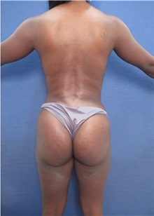 Tummy Tuck After Photo by Arian Mowlavi, MD; Laguna Beach, CA - Case 35225