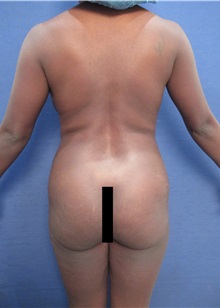 Tummy Tuck Before Photo by Arian Mowlavi, MD; Laguna Beach, CA - Case 35225