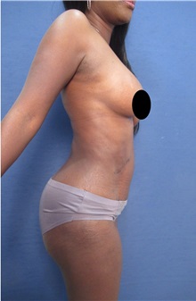 Tummy Tuck After Photo by Arian Mowlavi, MD; Laguna Beach, CA - Case 35225