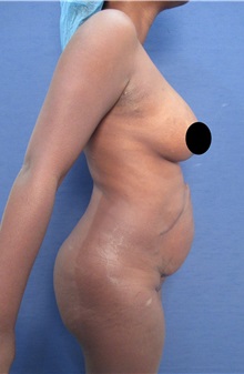 Tummy Tuck Before Photo by Arian Mowlavi, MD; Laguna Beach, CA - Case 35225