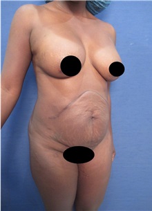 Tummy Tuck Before Photo by Arian Mowlavi, MD; Laguna Beach, CA - Case 35225