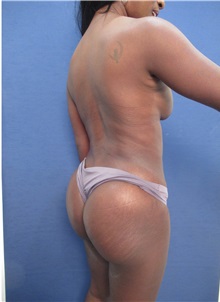 Tummy Tuck After Photo by Arian Mowlavi, MD; Laguna Beach, CA - Case 35225