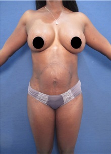 Tummy Tuck After Photo by Arian Mowlavi, MD; Laguna Beach, CA - Case 35225