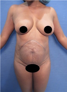 Tummy Tuck Before Photo by Arian Mowlavi, MD; Laguna Beach, CA - Case 35225