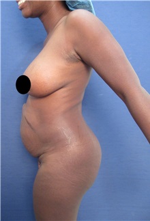Tummy Tuck Before Photo by Arian Mowlavi, MD; Laguna Beach, CA - Case 35225