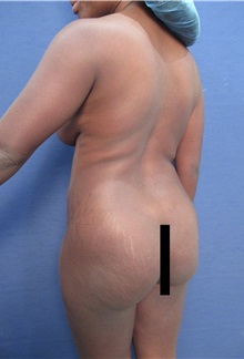 Tummy Tuck Before Photo by Arian Mowlavi, MD; Laguna Beach, CA - Case 35225