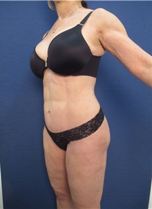Buttock Lift with Augmentation After Photo by Arian Mowlavi, MD; Laguna Beach, CA - Case 35227