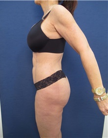 Buttock Lift with Augmentation After Photo by Arian Mowlavi, MD; Laguna Beach, CA - Case 35227