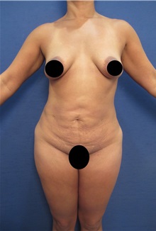 Buttock Implants Before Photo by Arian Mowlavi, MD; Laguna Beach, CA - Case 35362