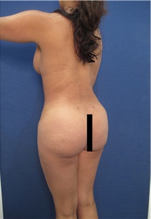 Buttock Implants After Photo by Arian Mowlavi, MD; Laguna Beach, CA - Case 35362