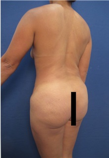 Buttock Implants Before Photo by Arian Mowlavi, MD; Laguna Beach, CA - Case 35362