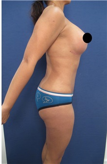 Buttock Implants After Photo by Arian Mowlavi, MD; Laguna Beach, CA - Case 35362