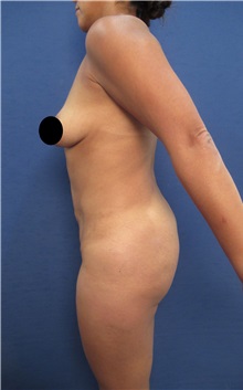Buttock Lift with Augmentation Before Photo by Arian Mowlavi, MD; Laguna Beach, CA - Case 35365