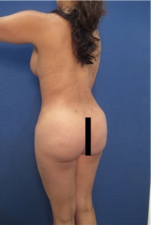 Buttock Lift with Augmentation After Photo by Arian Mowlavi, MD; Laguna Beach, CA - Case 35365