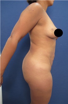 Buttock Lift with Augmentation Before Photo by Arian Mowlavi, MD; Laguna Beach, CA - Case 35365