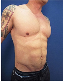 Body Contouring After Photo by Arian Mowlavi, MD; Laguna Beach, CA - Case 35382