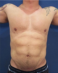 Body Contouring After Photo by Arian Mowlavi, MD; Laguna Beach, CA - Case 35382