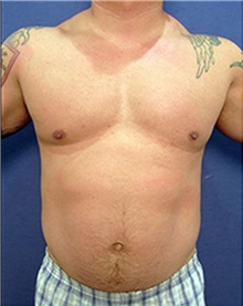Body Contouring Before Photo by Arian Mowlavi, MD; Laguna Beach, CA - Case 35382