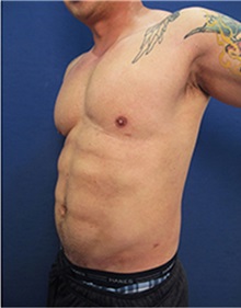 Body Contouring After Photo by Arian Mowlavi, MD; Laguna Beach, CA - Case 35382