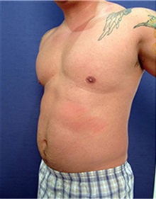 Body Contouring Before Photo by Arian Mowlavi, MD; Laguna Beach, CA - Case 35382