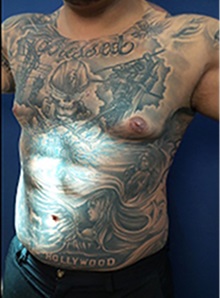 Liposuction After Photo by Arian Mowlavi, MD; Laguna Beach, CA - Case 35385