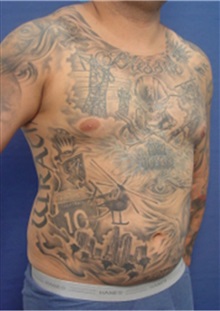 Liposuction Before Photo by Arian Mowlavi, MD; Laguna Beach, CA - Case 35385