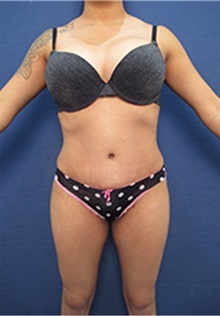 Body Contouring After Photo by Arian Mowlavi, MD; Laguna Beach, CA - Case 35422