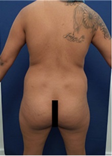 Buttock Lift with Augmentation Before Photo by Arian Mowlavi, MD; Laguna Beach, CA - Case 35423