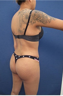 Buttock Lift with Augmentation After Photo by Arian Mowlavi, MD; Laguna Beach, CA - Case 35423