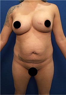 Liposuction Before Photo by Arian Mowlavi, MD; Laguna Beach, CA - Case 35427