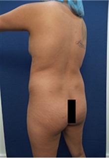 Liposuction Before Photo by Arian Mowlavi, MD; Laguna Beach, CA - Case 35427