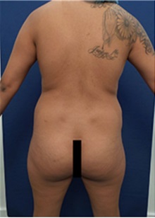 Tummy Tuck Before Photo by Arian Mowlavi, MD; Laguna Beach, CA - Case 35430