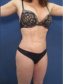 Buttock Lift with Augmentation After Photo by Arian Mowlavi, MD; Laguna Beach, CA - Case 35443