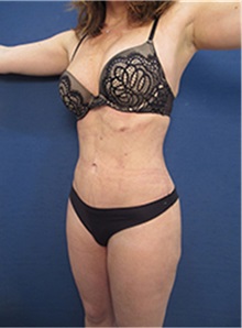 Buttock Lift with Augmentation After Photo by Arian Mowlavi, MD; Laguna Beach, CA - Case 35443